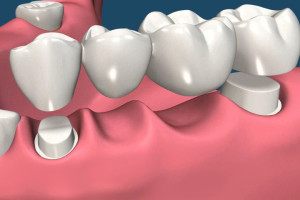 Dental bridge