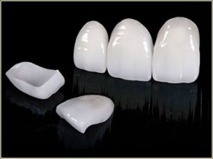 PORCELAIN-VENEERS